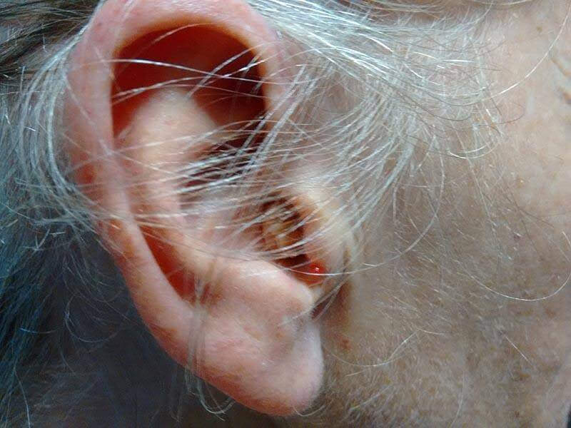 ear infections hearing know loss infection stigma need hearingaidknow